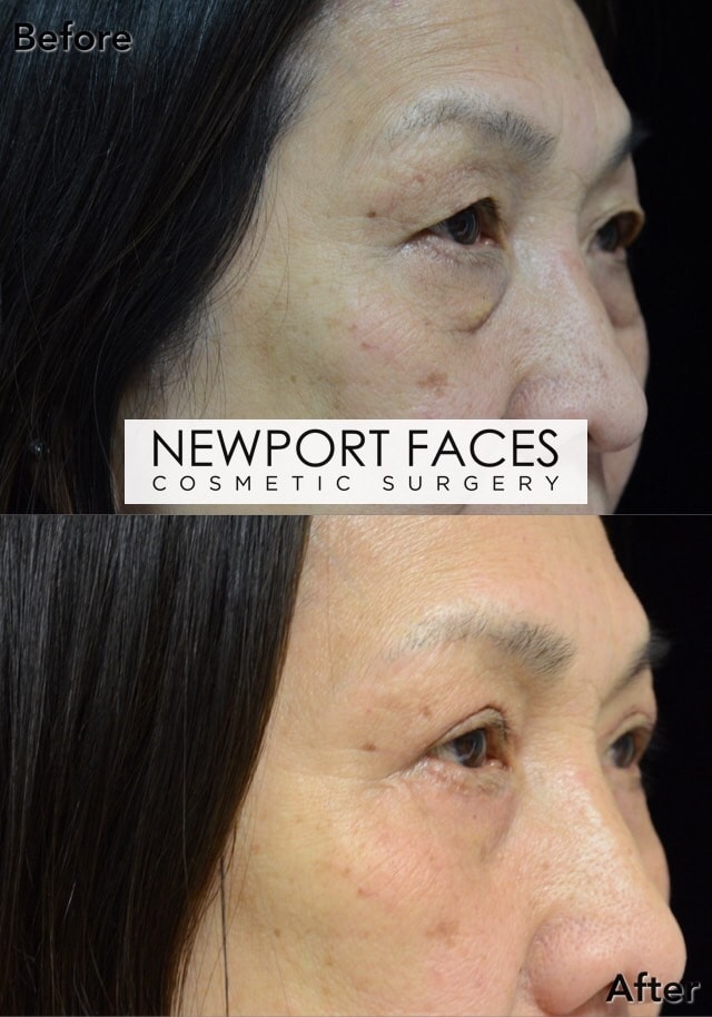 A result from Newport Faces Cosmetic Surgery