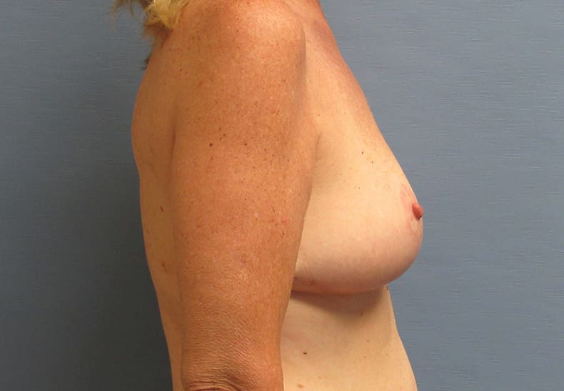 A result from Parkcrest Plastic Surgery