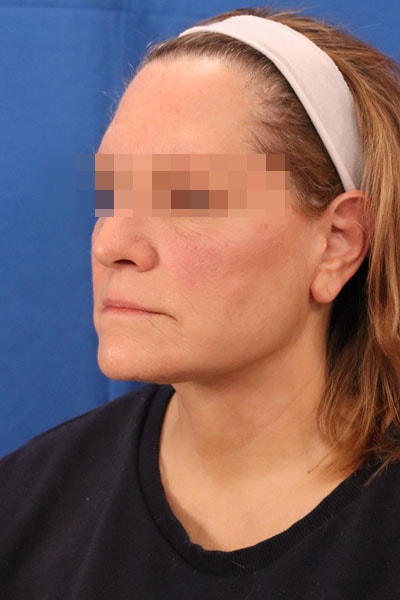 A result from Seacoast Plastic Surgery and Medical Aesthetics
