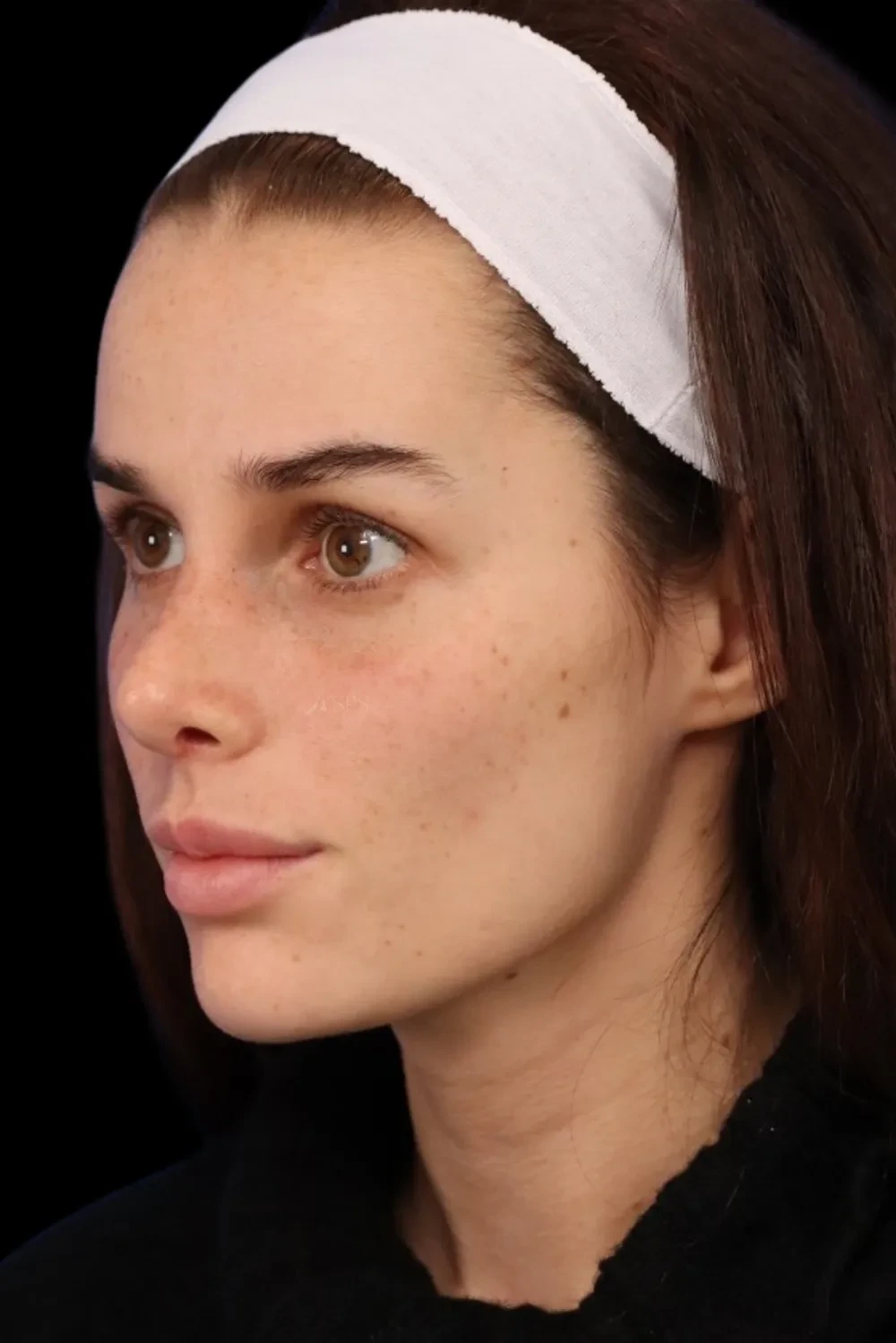 A result from Seacoast Plastic Surgery and Medical Aesthetics