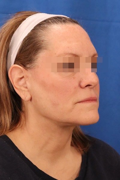 A result from Seacoast Plastic Surgery and Medical Aesthetics