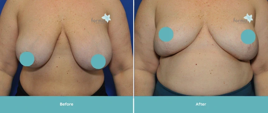A result from Forma Plastic Surgery