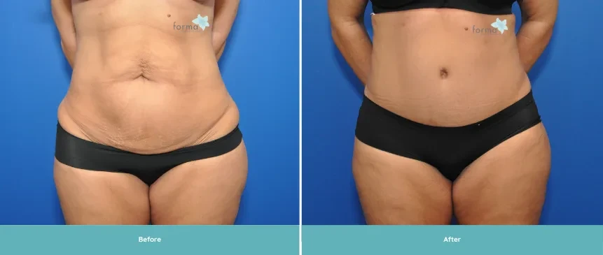 A result from Forma Plastic Surgery