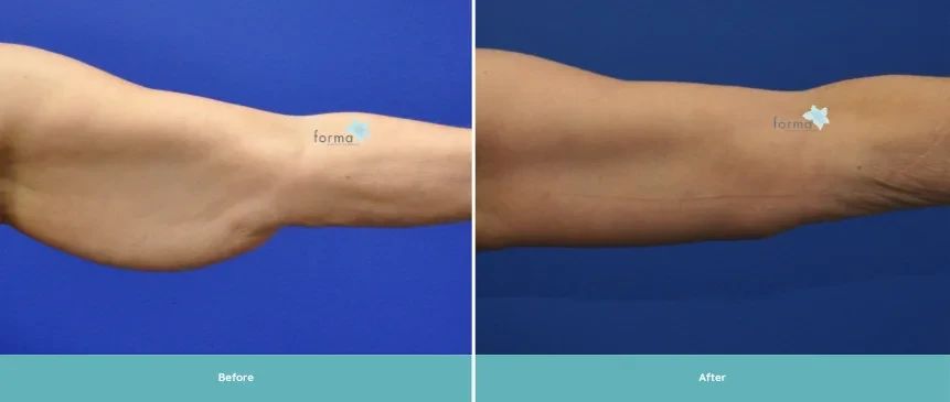 A result from Forma Plastic Surgery