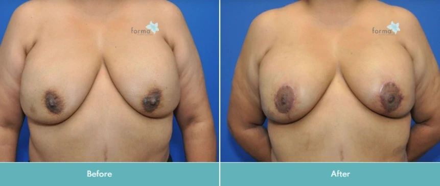 A result from Forma Plastic Surgery