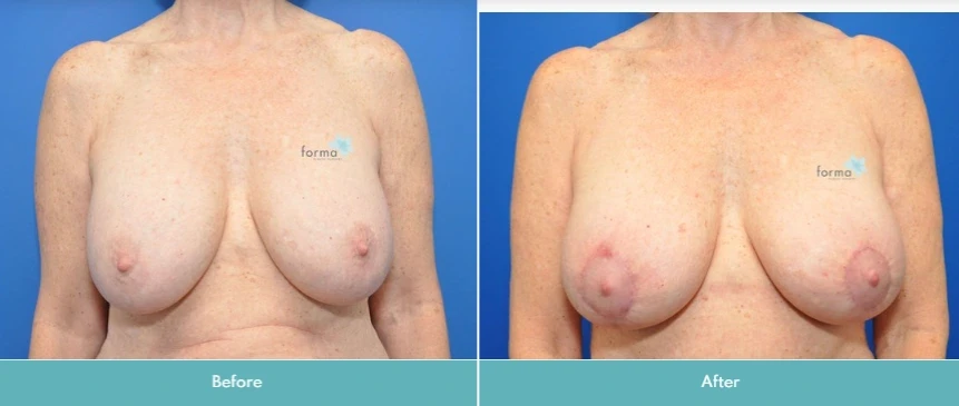 A result from Forma Plastic Surgery