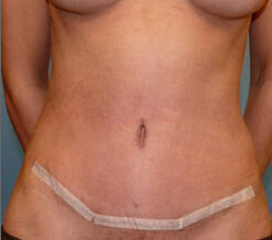 A result from Plastic Surgery Institute - Dr. Ritu Chopra
