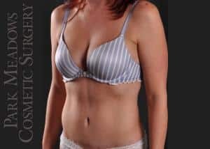 A result from Park Meadows Cosmetic Surgery
