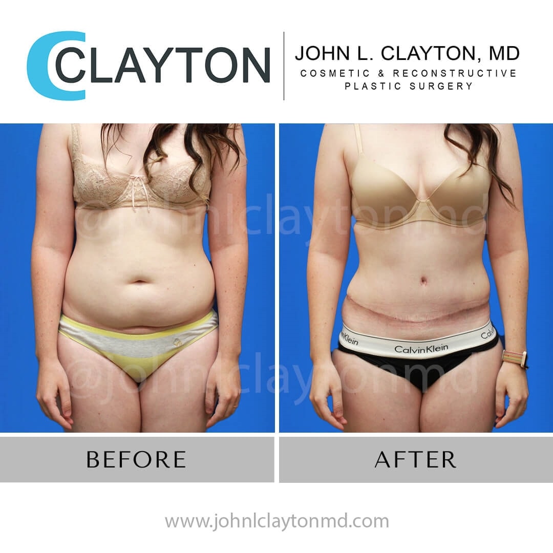 Liposuction before and after results
