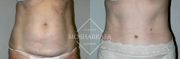 A result from Tamir Mosharrafa, MD