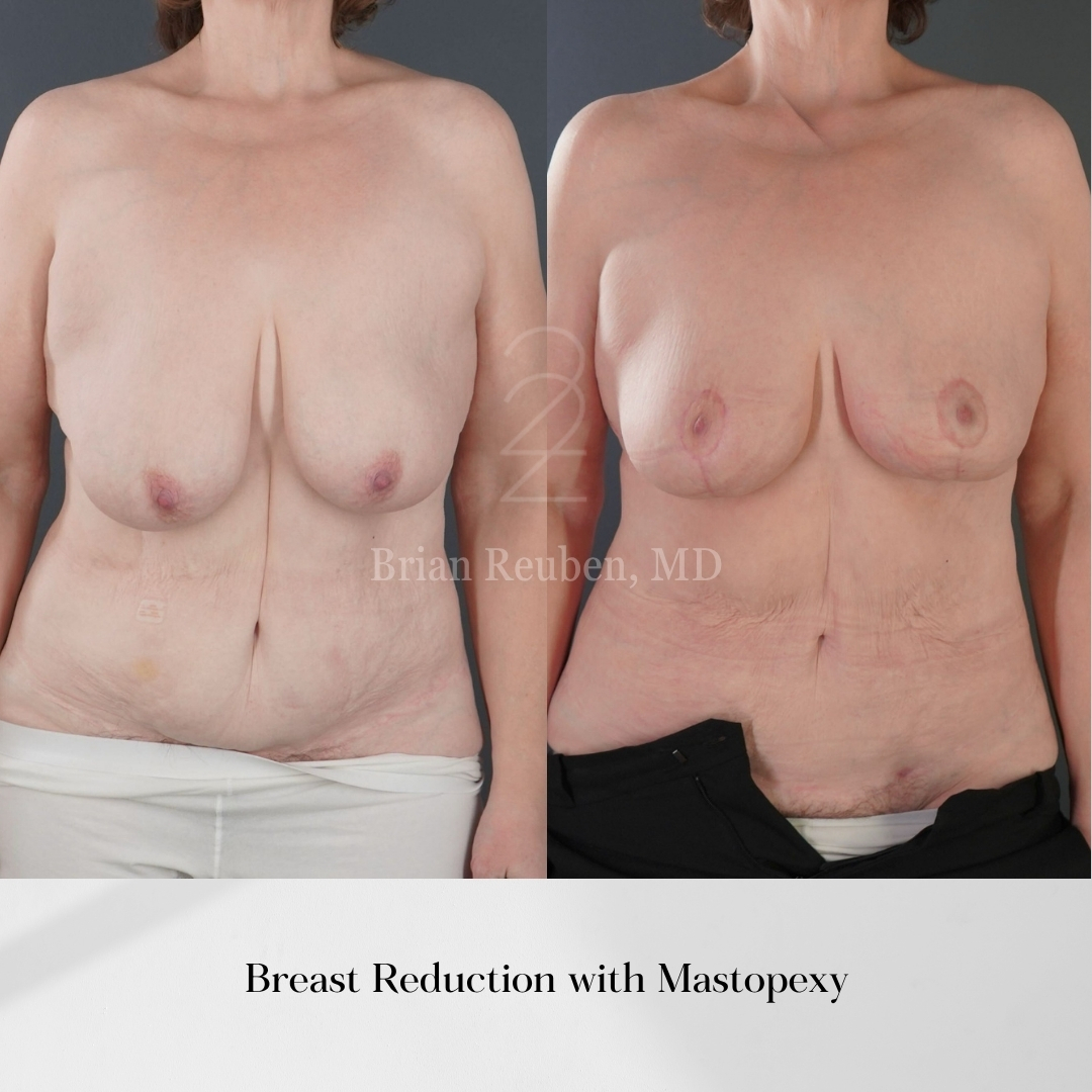 A result from 22 Plastic Surgery & Spa MD