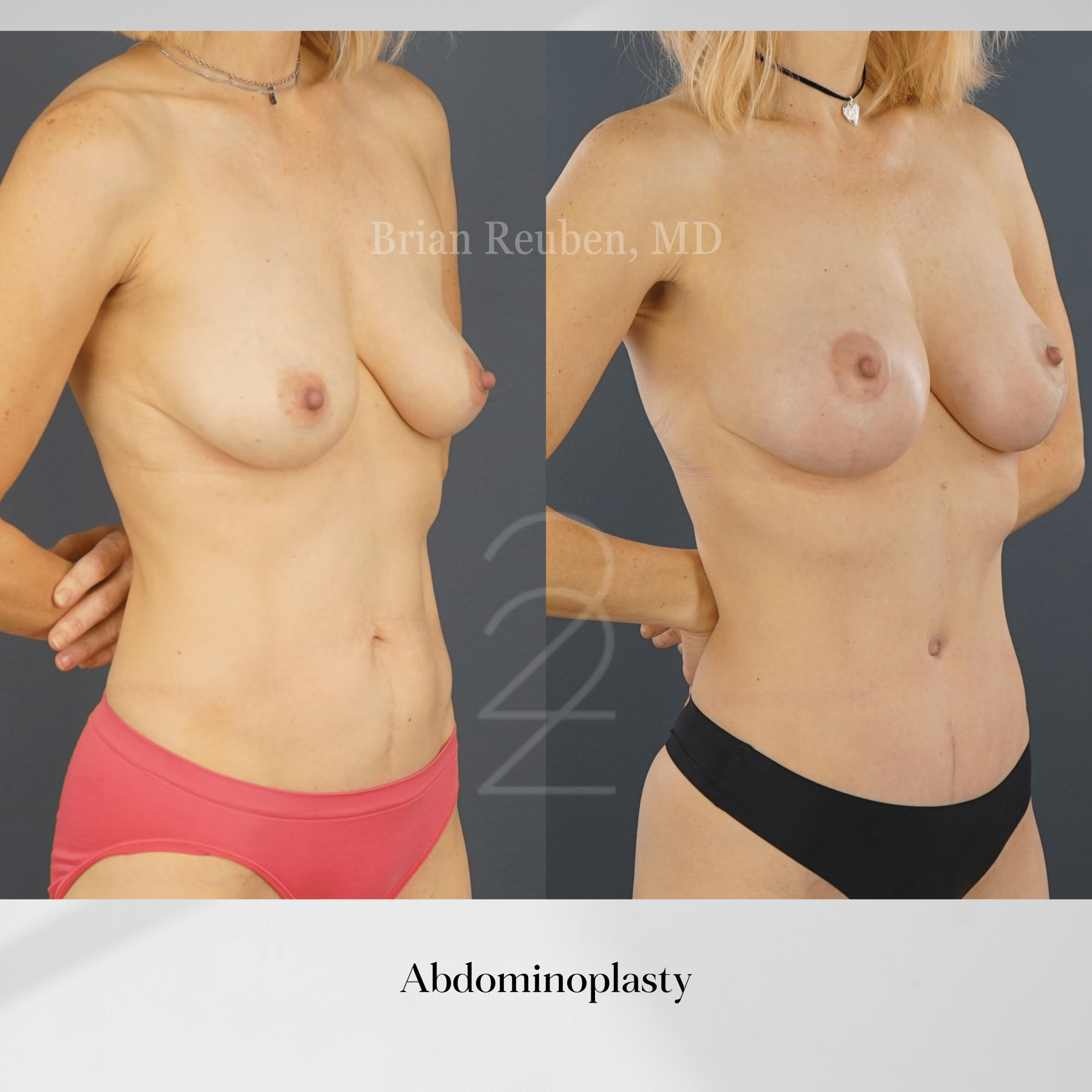 A result from 22 Plastic Surgery & Spa MD