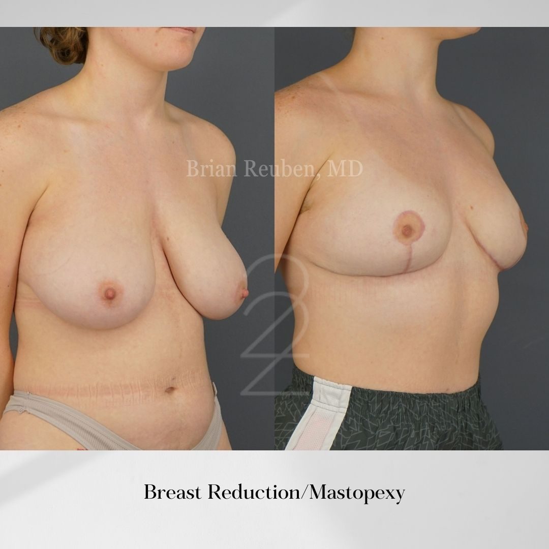 A result from 22 Plastic Surgery & Spa MD