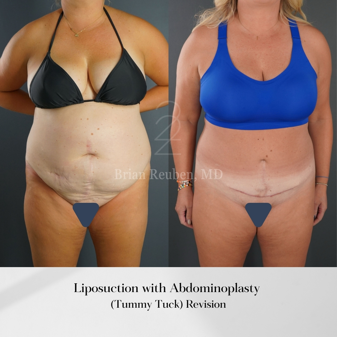 A result from 22 Plastic Surgery & Spa MD