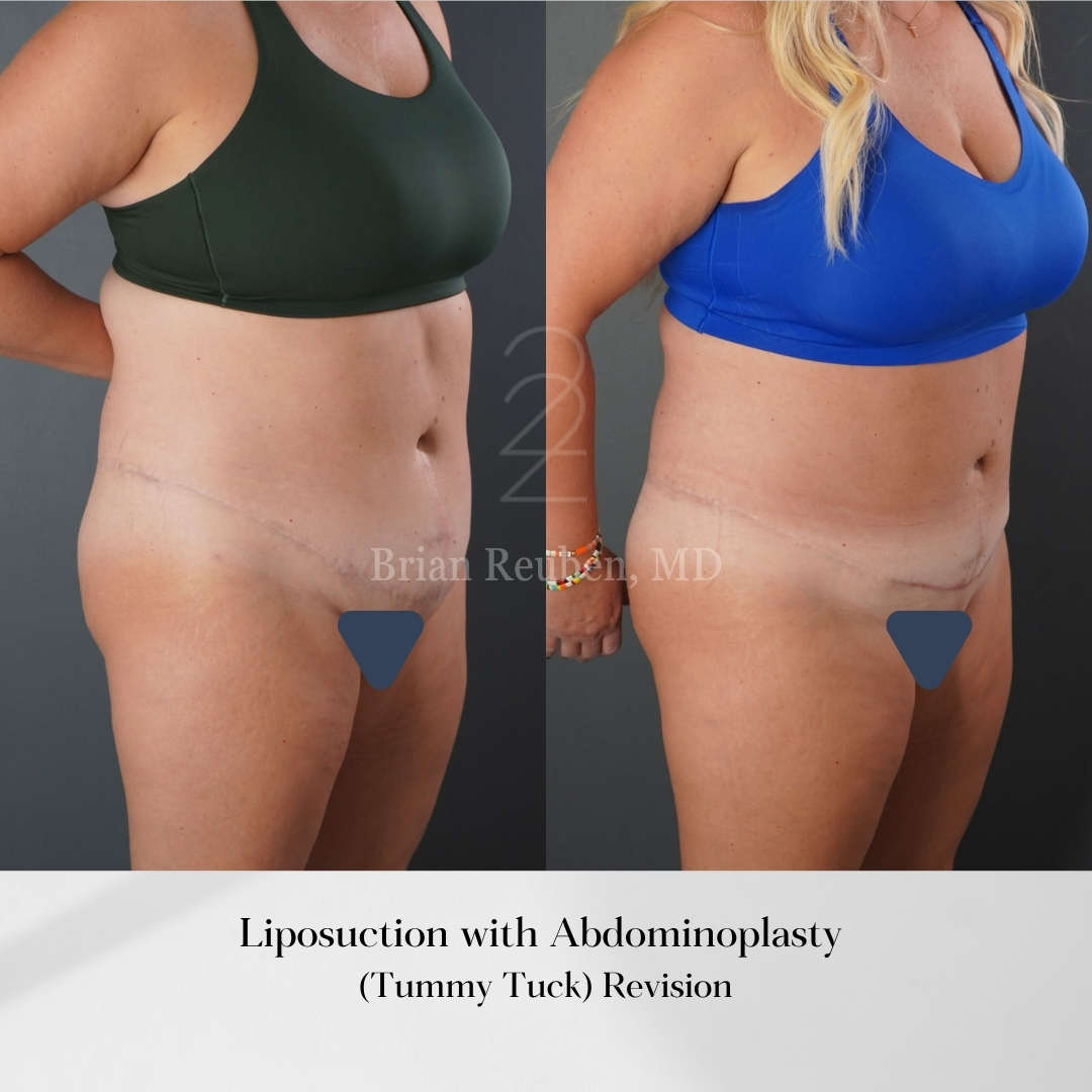A result from 22 Plastic Surgery & Spa MD