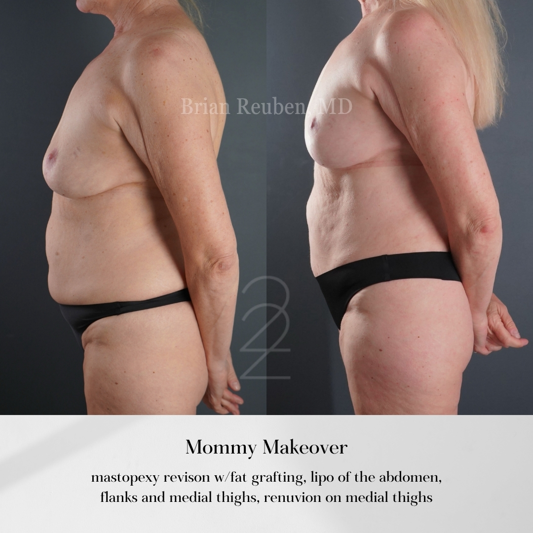 A result from 22 Plastic Surgery & Spa MD