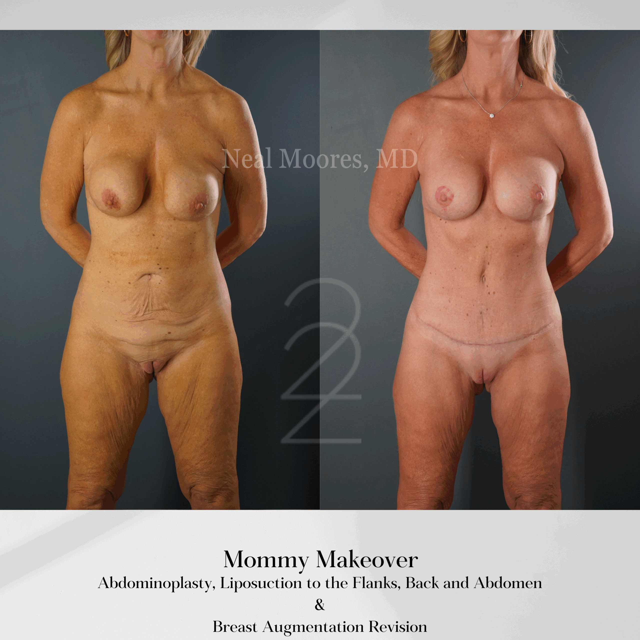 A result from 22 Plastic Surgery & Spa MD