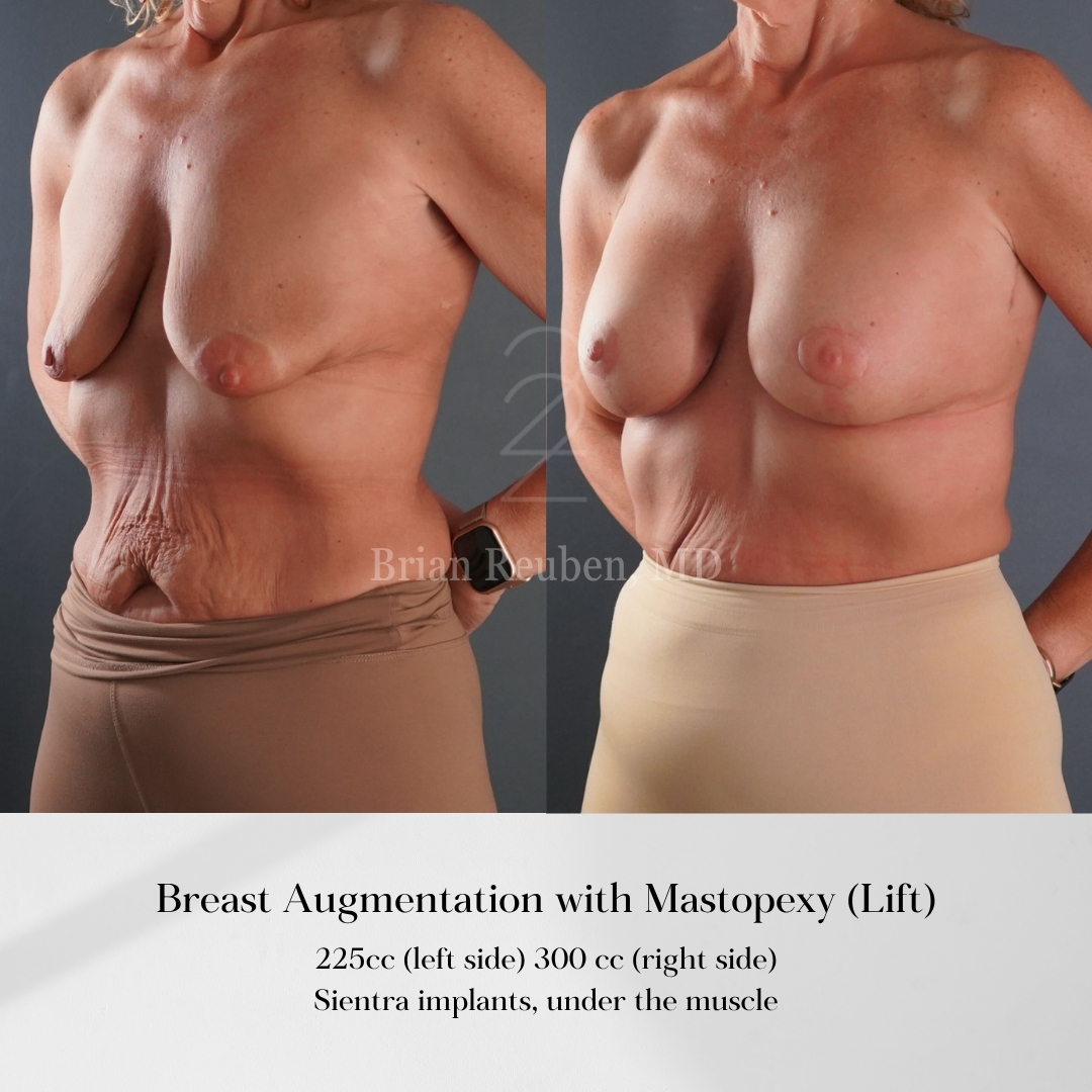 A result from 22 Plastic Surgery & Spa MD