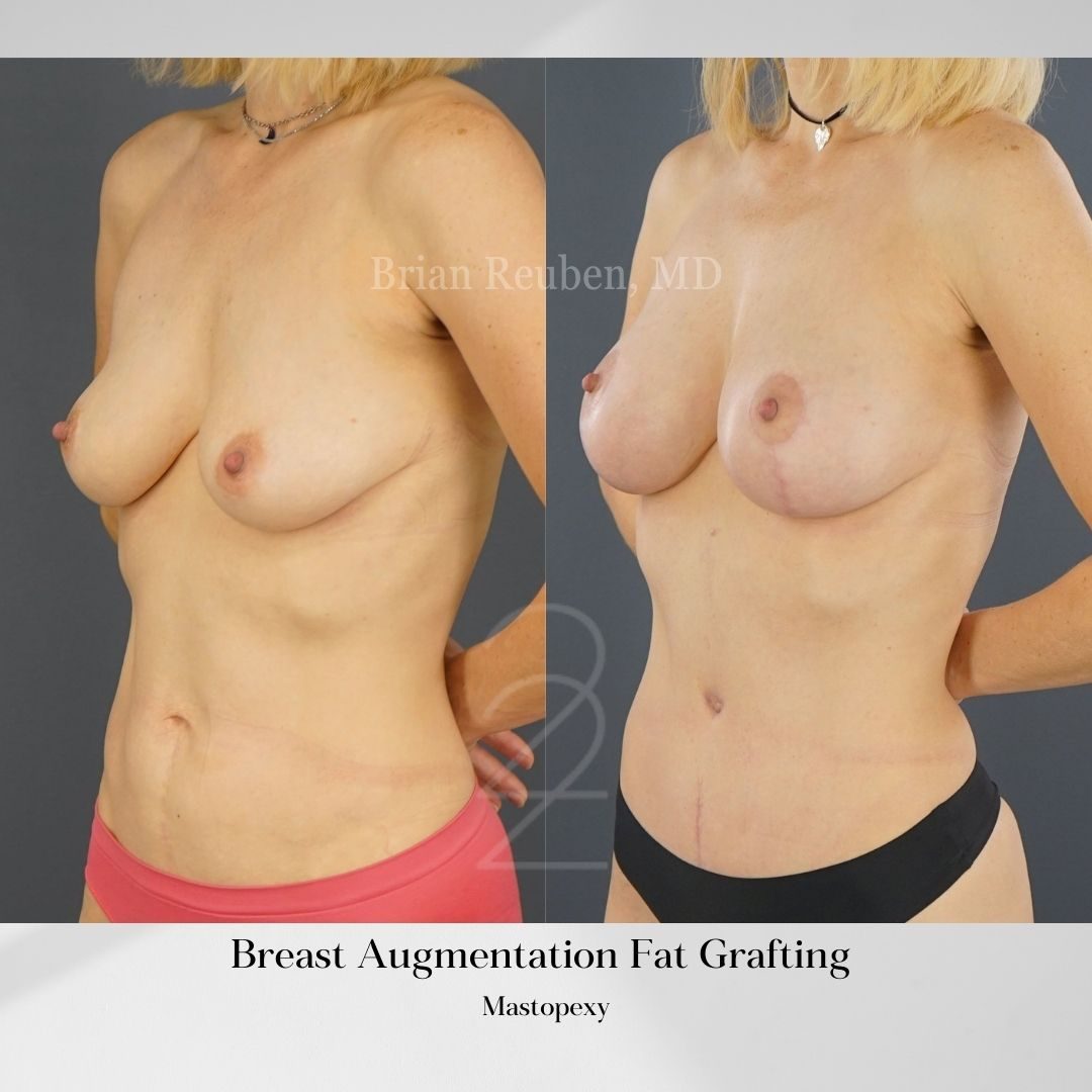 A result from 22 Plastic Surgery & Spa MD
