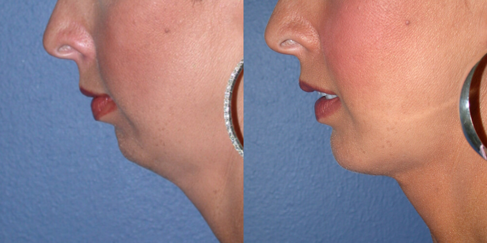 A result from Gallas Plastic Surgery