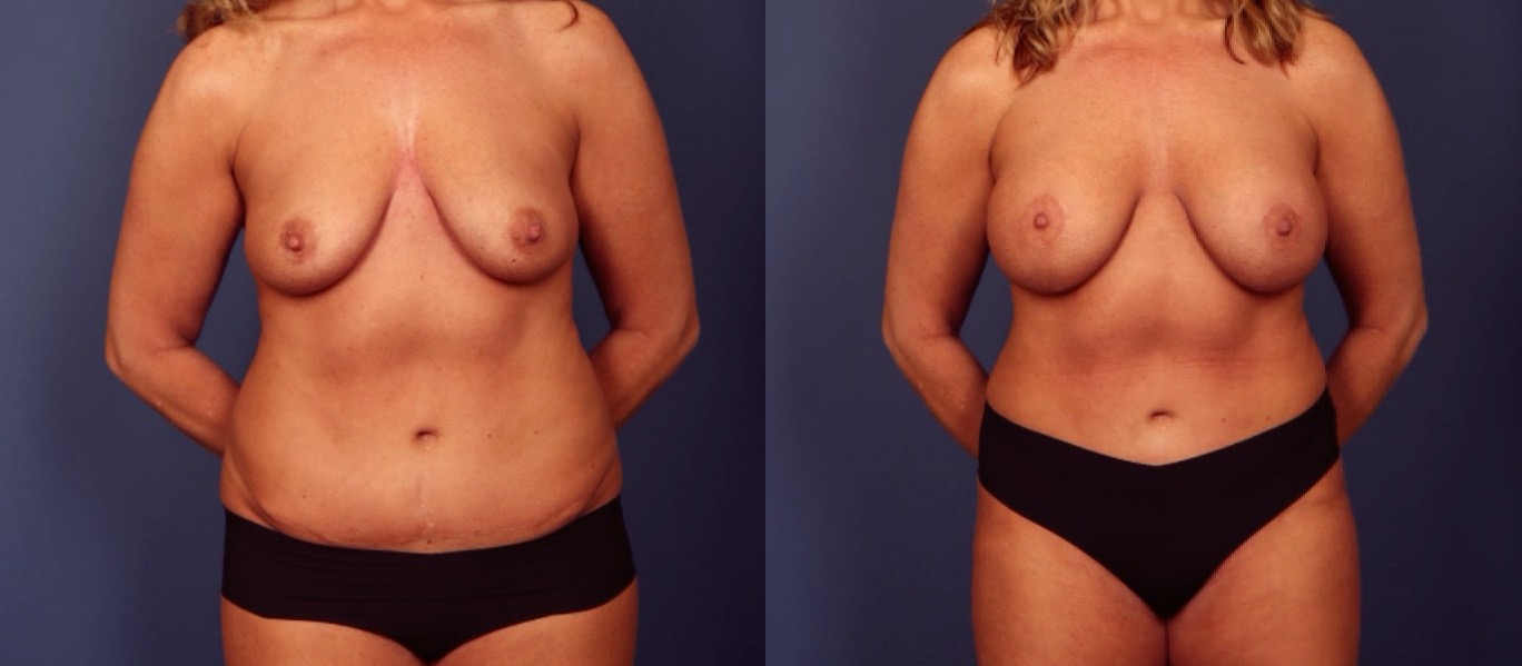 A result from Gallas Plastic Surgery
