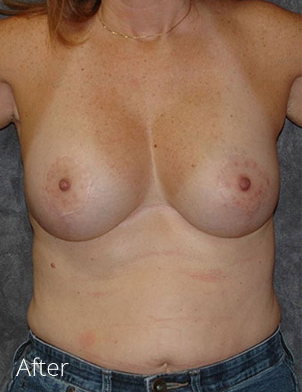 A result from Lohner Plastic Surgery