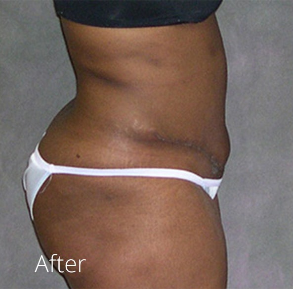 A result from Lohner Plastic Surgery