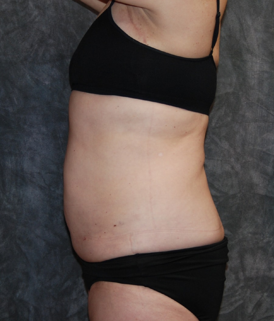 A result from Lohner Plastic Surgery