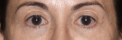 A result from Lohner Plastic Surgery