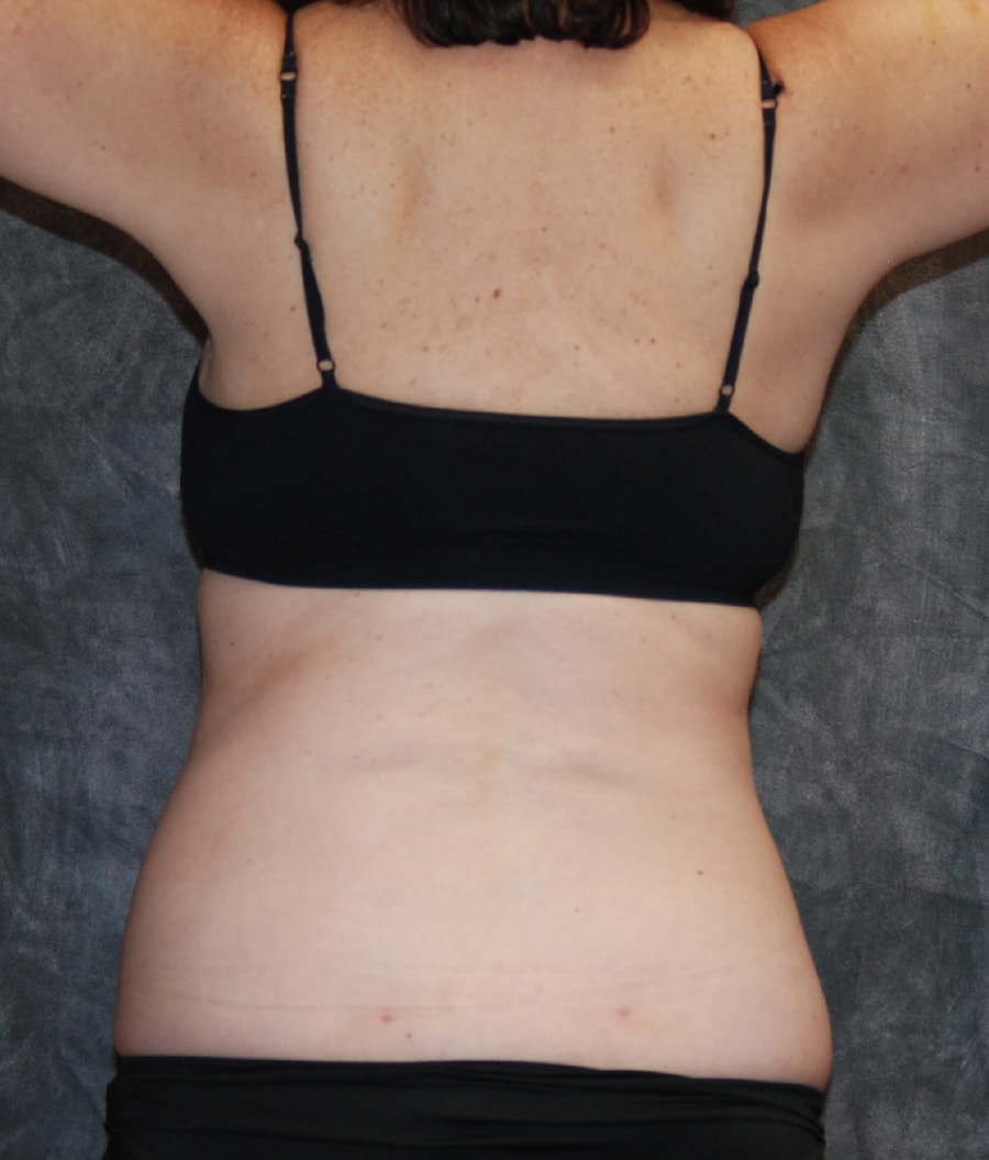 A result from Lohner Plastic Surgery
