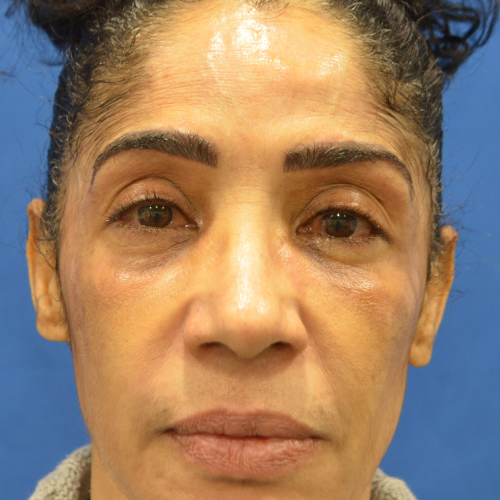 A result from Philadelphia Facial Plastic Surgery & Medspa