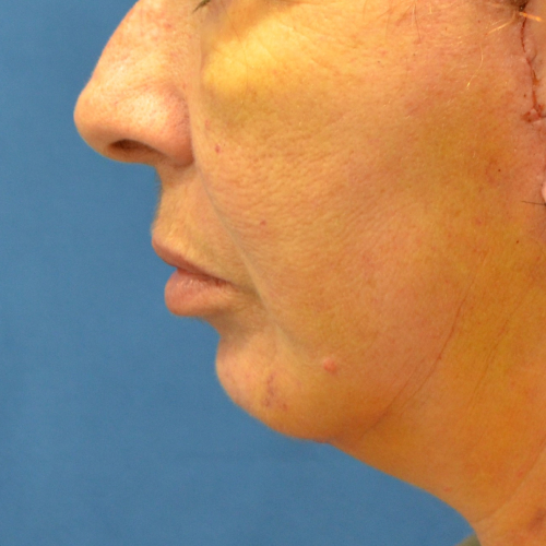 A result from Philadelphia Facial Plastic Surgery & Medspa