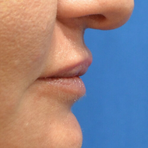 A result from Philadelphia Facial Plastic Surgery & Medspa