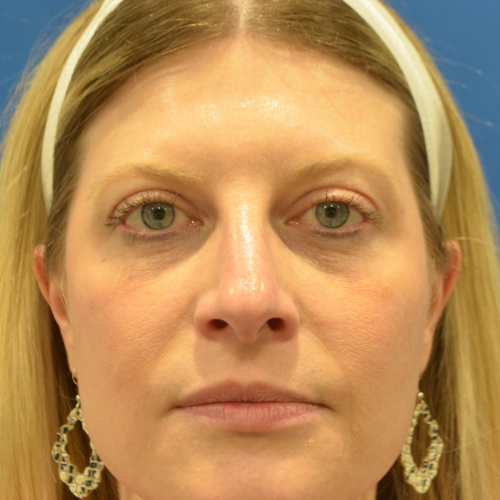 A result from Philadelphia Facial Plastic Surgery & Medspa