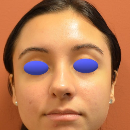 A result from Philadelphia Facial Plastic Surgery & Medspa