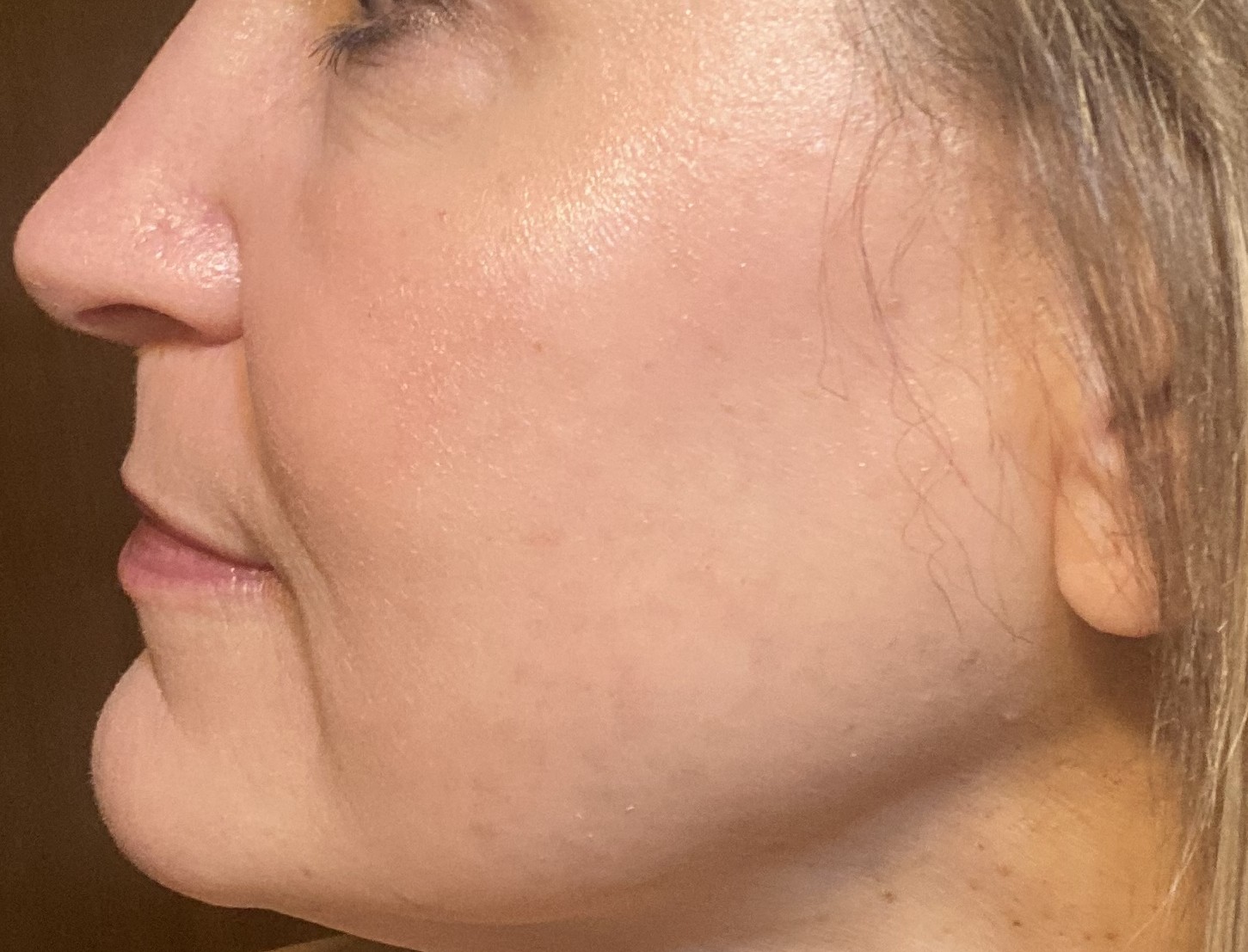 A result from Bellissimo Plastic Surgery & Medi Spa