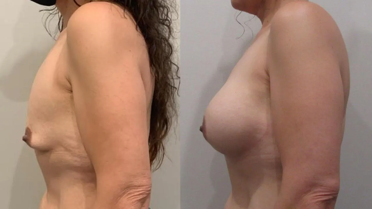 Breast Augmentation result at NassifMD® Plastic Surgery