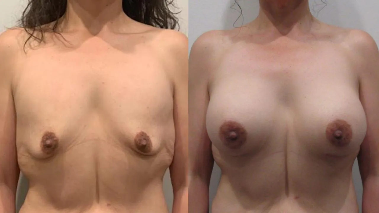 Breast Augmentation before photo