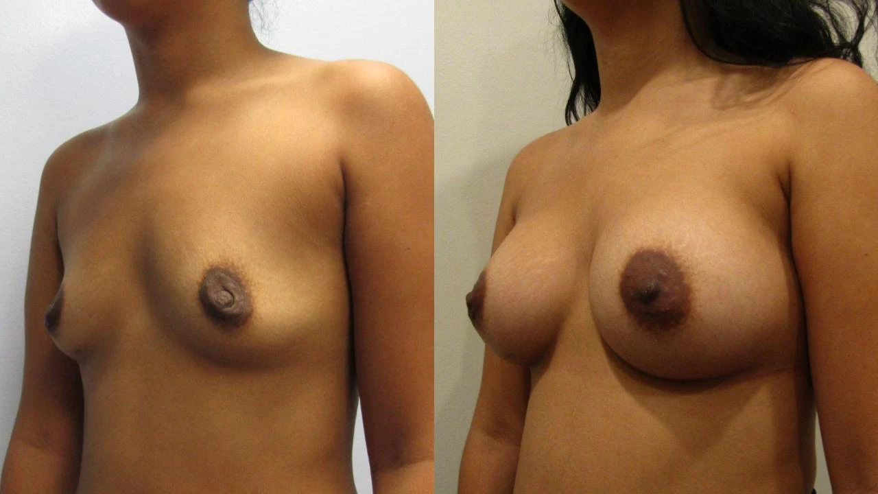 Breast Augmentation result at NassifMD® Plastic Surgery