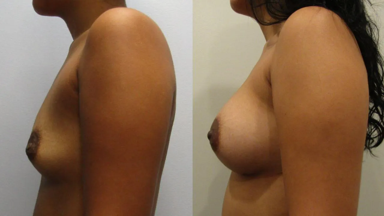 Breast Augmentation result at NassifMD® Plastic Surgery