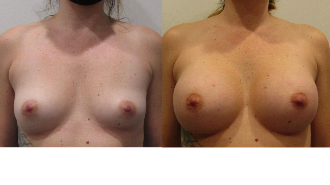 Breast Augmentation result at NassifMD® Plastic Surgery