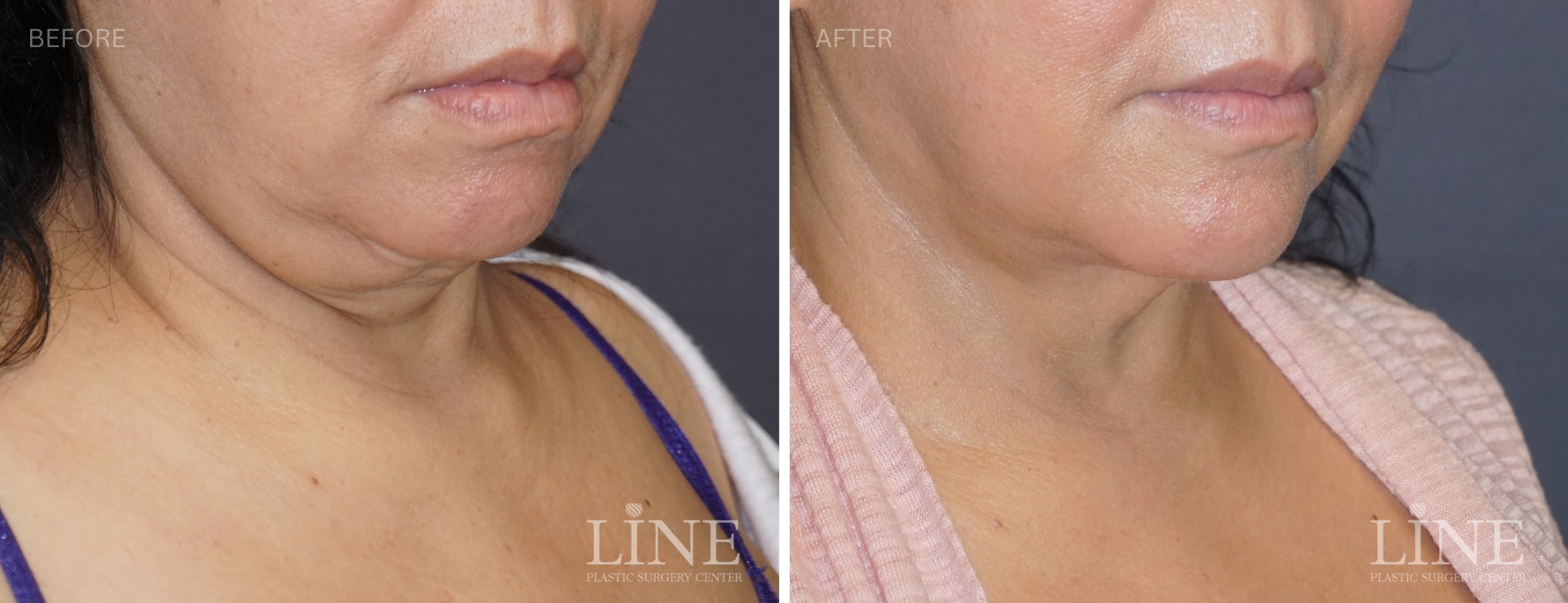 A result from Line Plastic Surgery Irvine