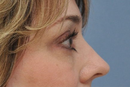 A result from OC Facial Plastic Surgery - Ali Sepehr, MD