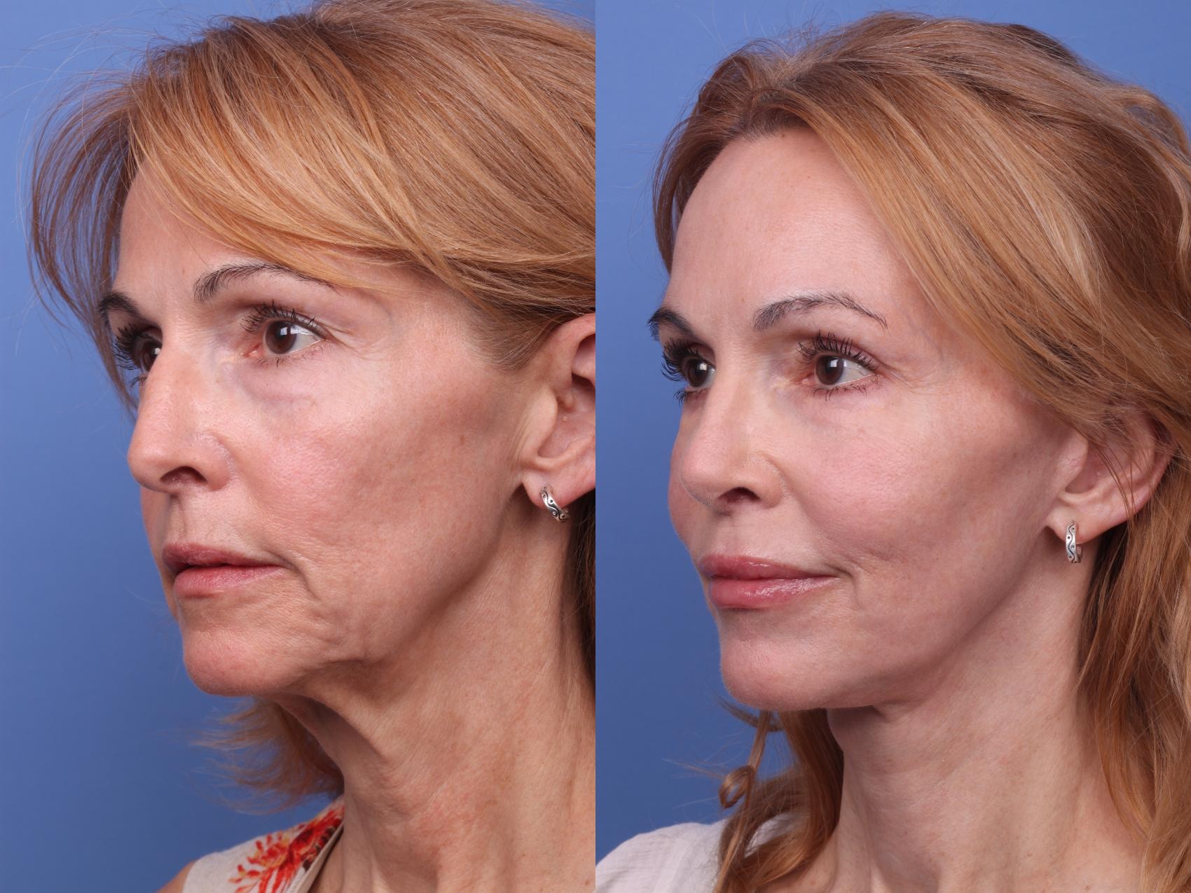A result from Todd Hobgood, MD