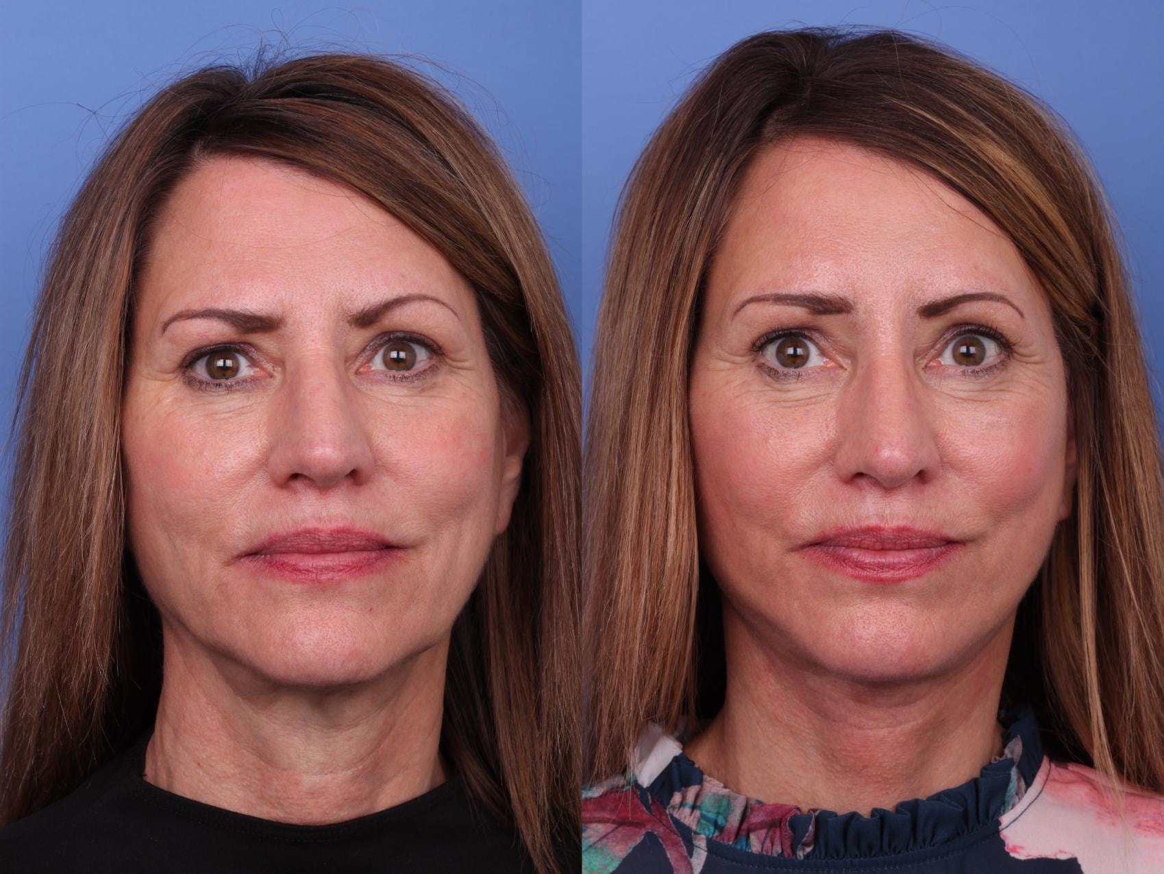 A result from Todd Hobgood, MD