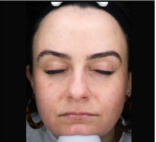 A result from Zuliani Facial Aesthetics: Dr. Giancarlo F. Zuliani, MD