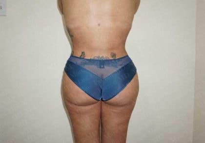 A result from Marc Everett, MD, FACS