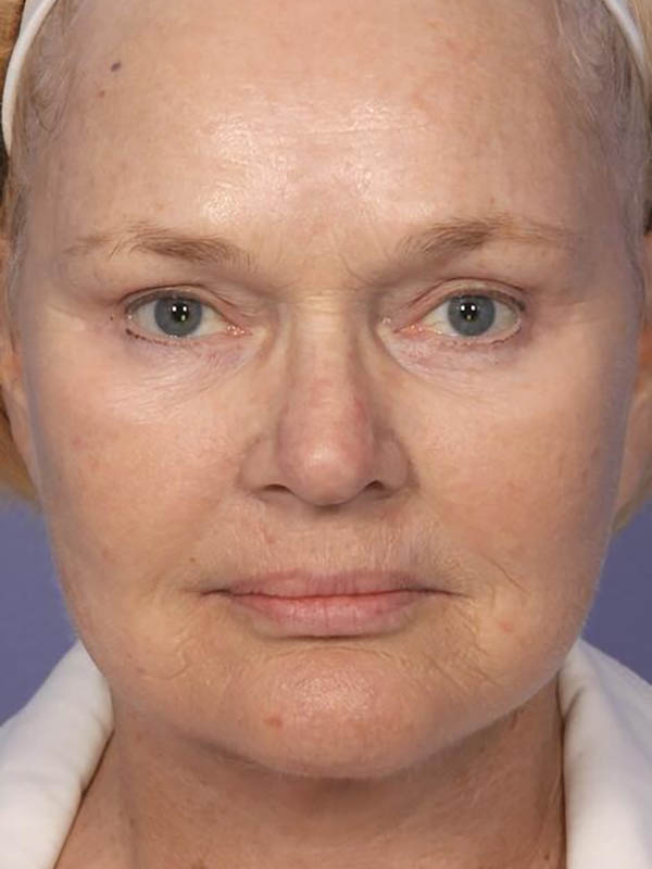 Facelift result at Marina Plastic Surgery