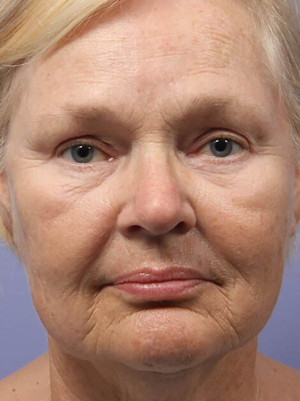 Facelift before photo