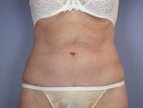 Tummy Tuck result at Marina Plastic Surgery